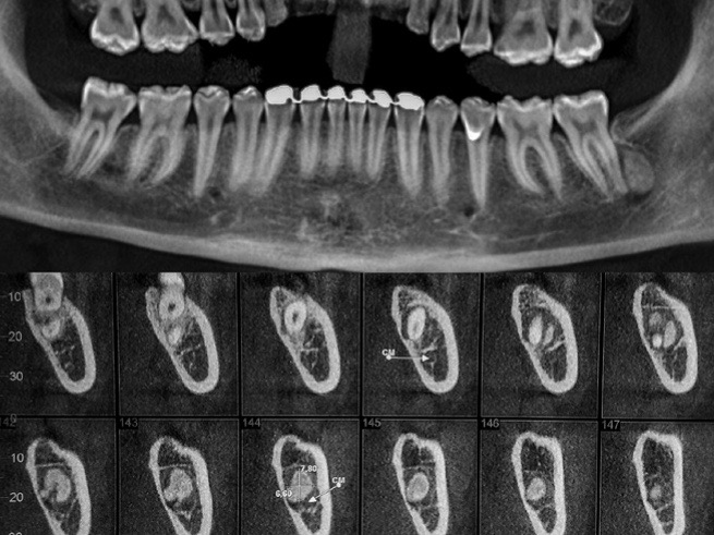 Osteoma de mandíbula: relato de caso
